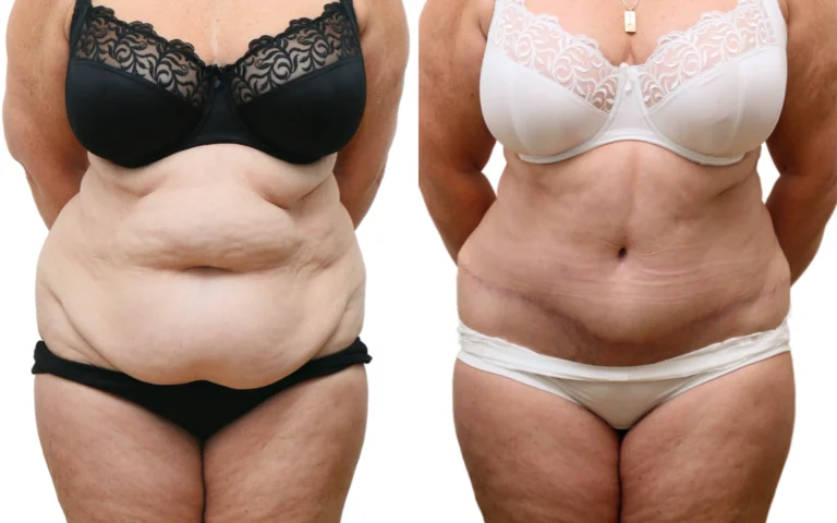 Transformational tummy tuck result at 6 months, before and after, photo 1 of 5