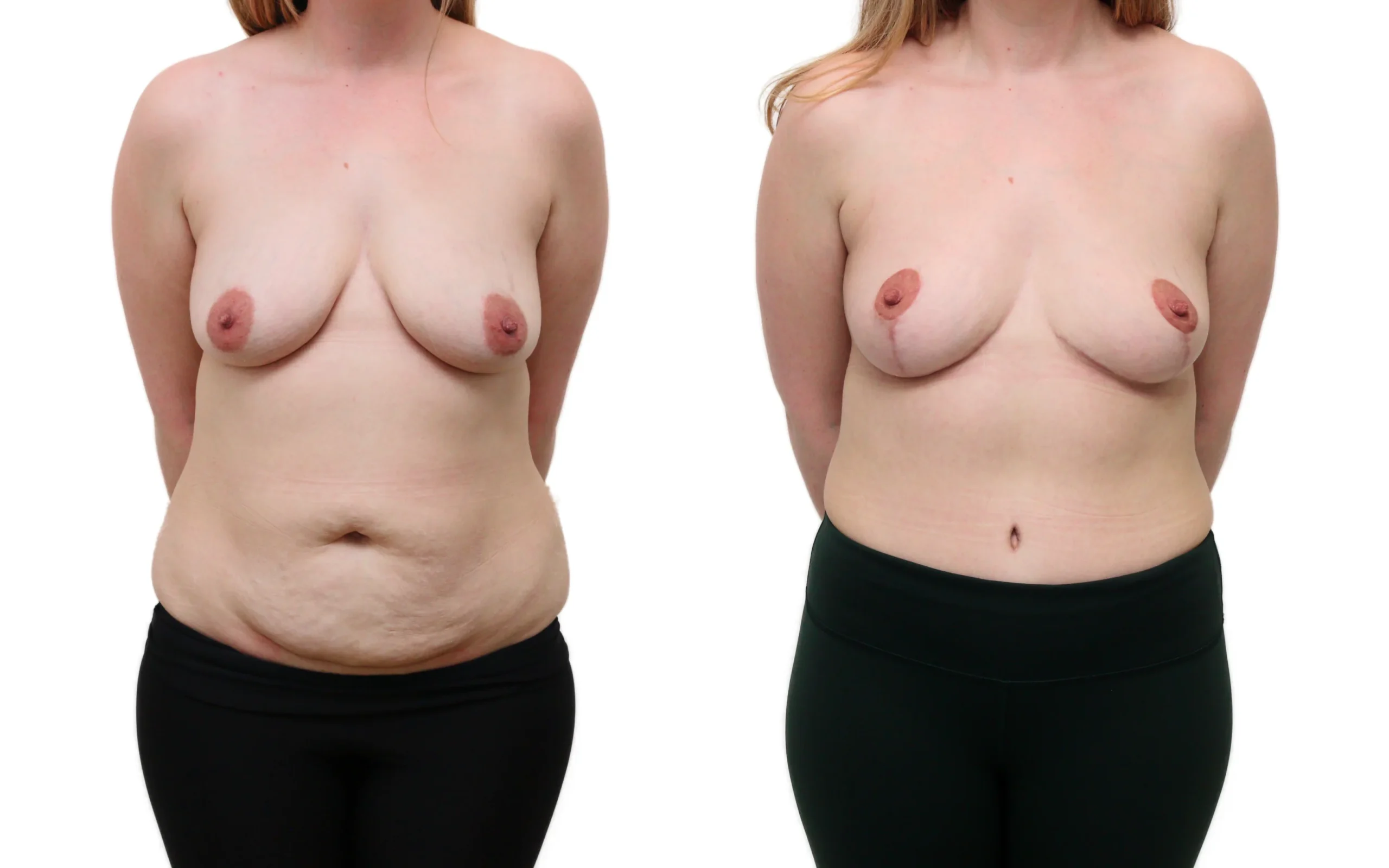 Combined Breast Uplift and Tummy Tuck After Pregnancy and Weight Loss