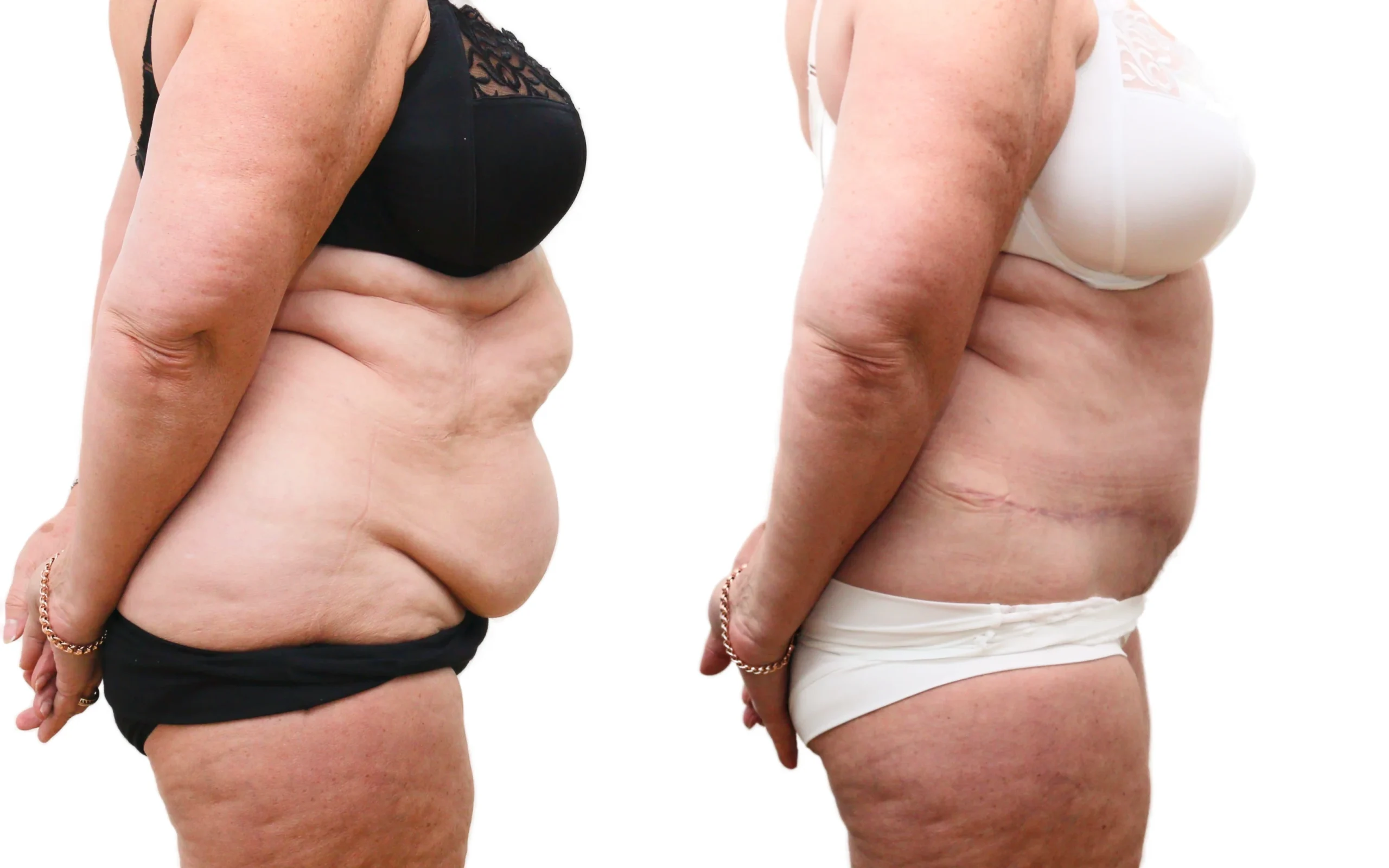 Transformational Tummy Tuck Result at 6 Months