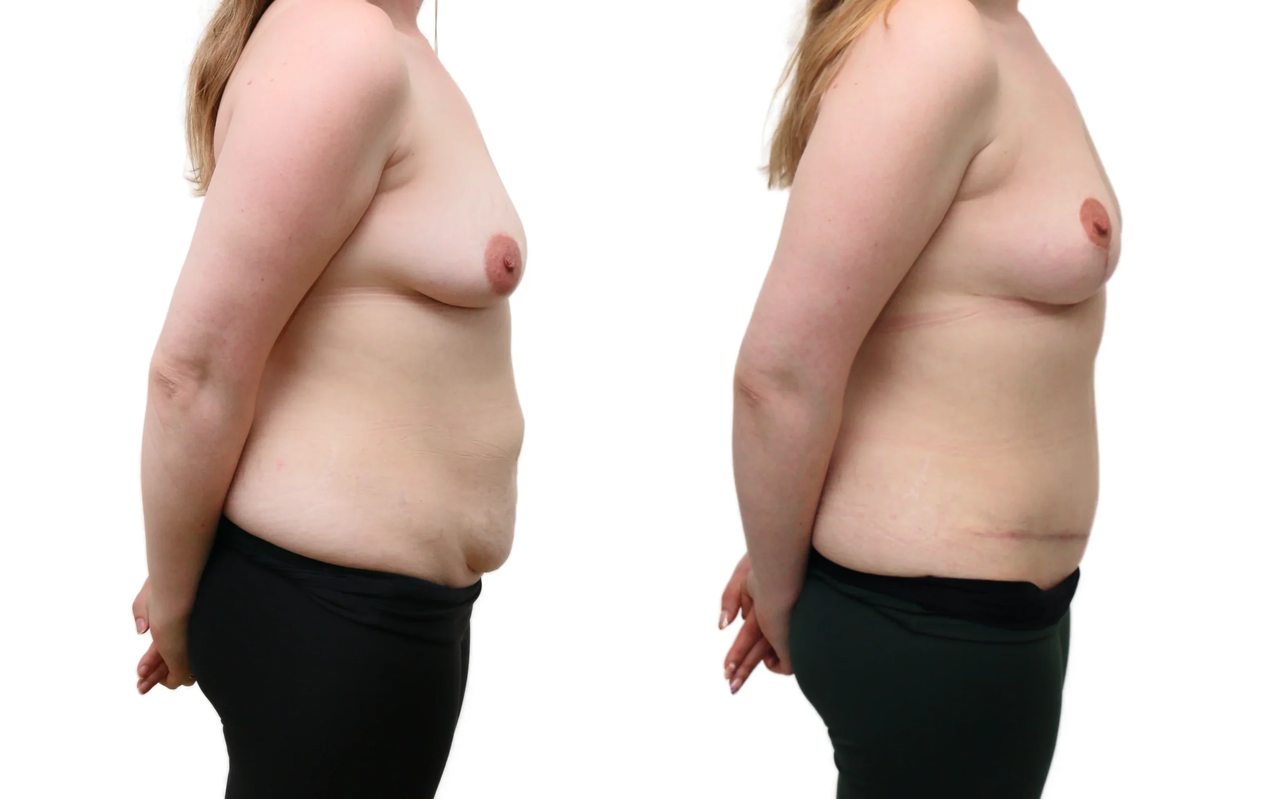 Combined Breast Uplift and Tummy Tuck After Pregnancy and Weight Loss