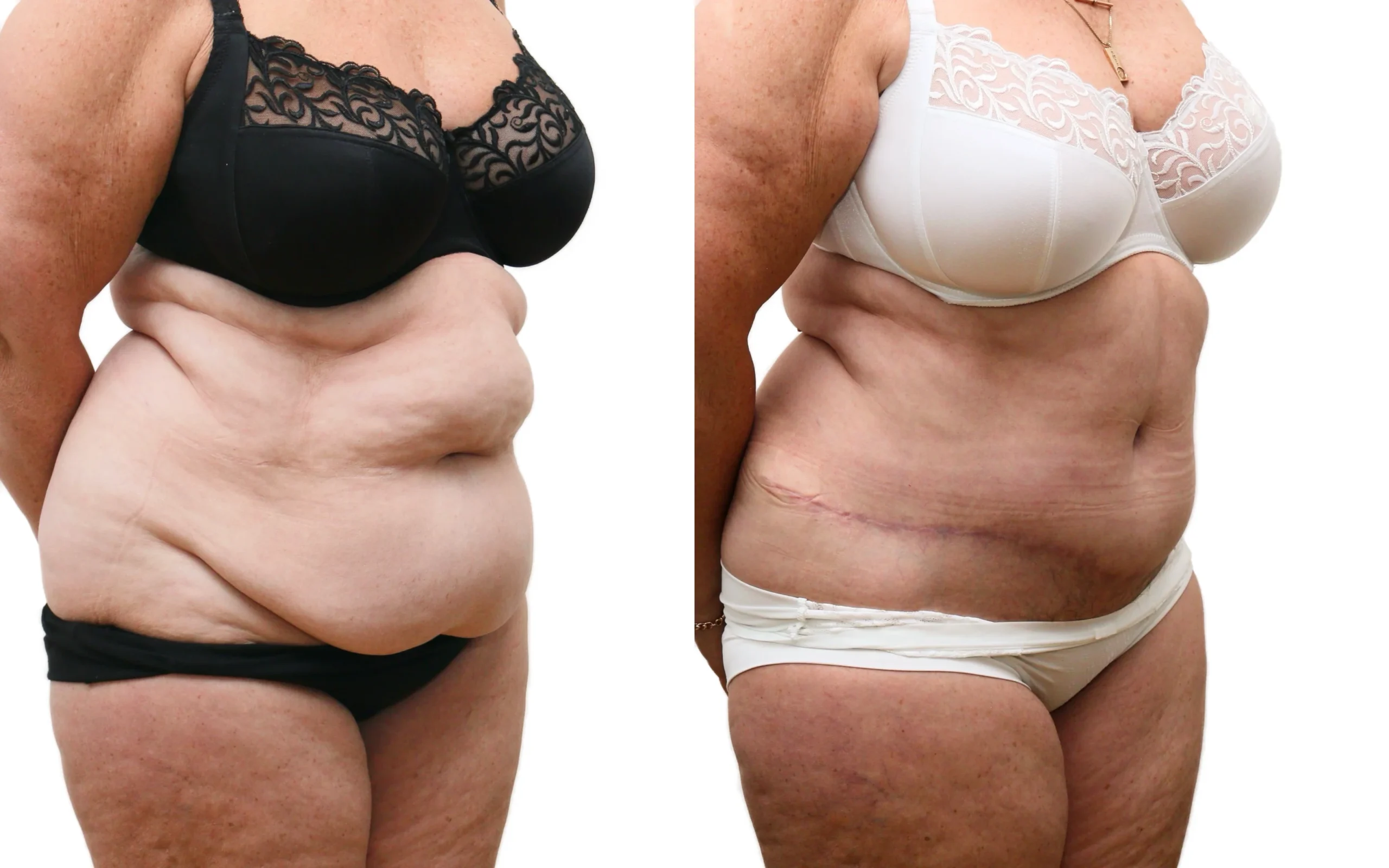 Transformational Tummy Tuck Result at 6 Months