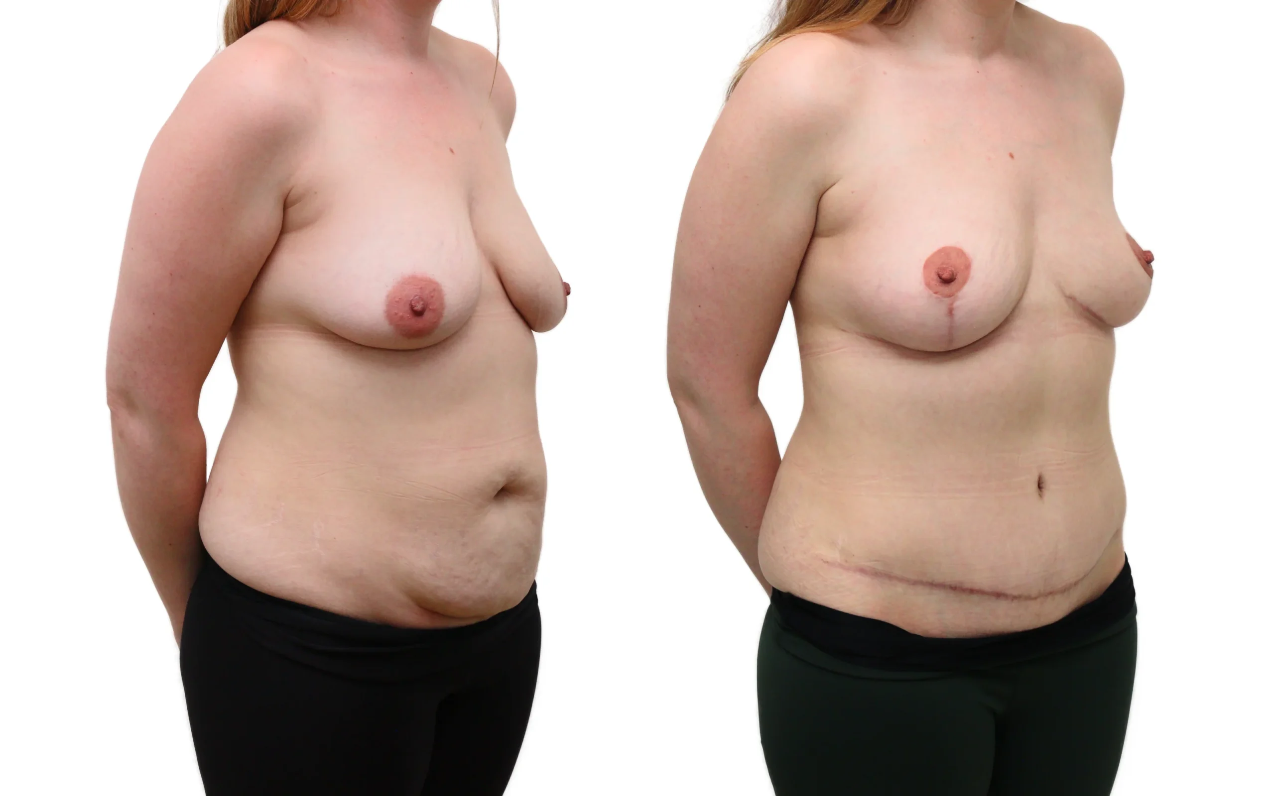 Combined Breast Uplift and Tummy Tuck After Pregnancy and Weight Loss
