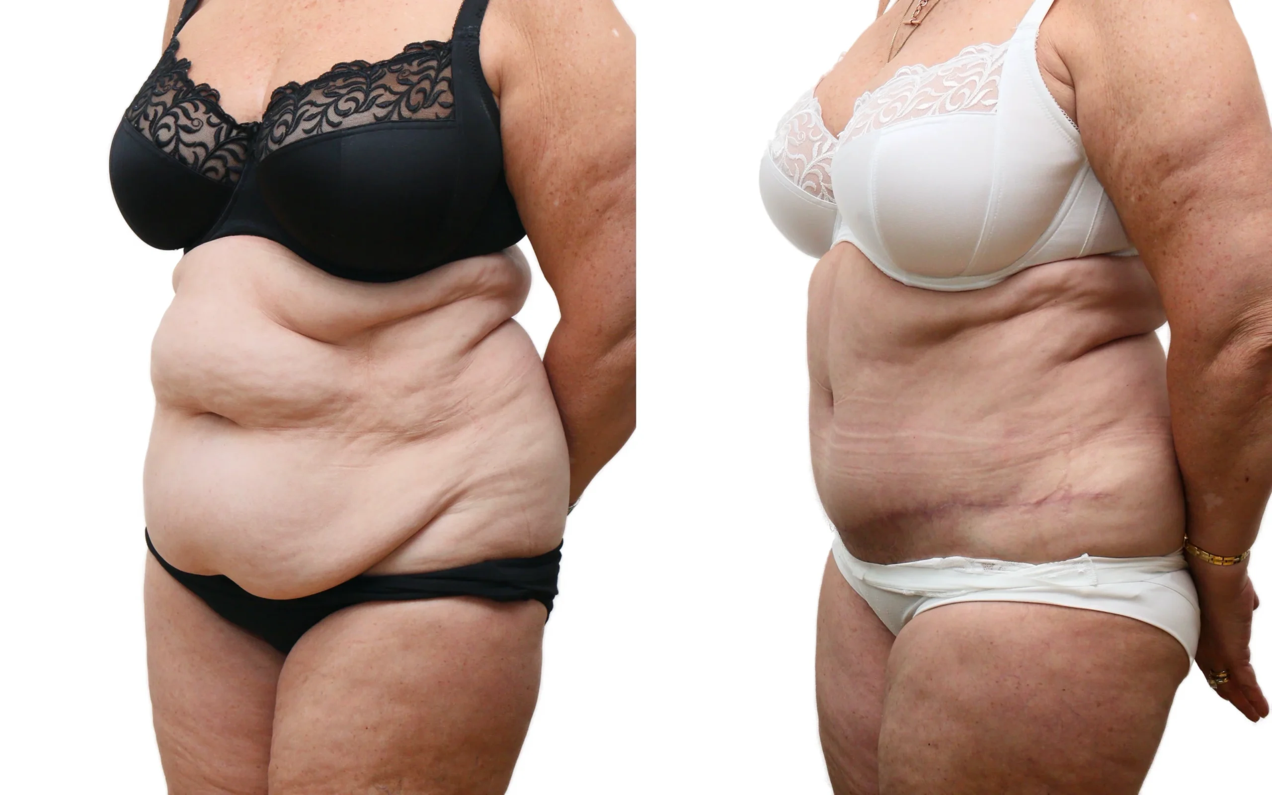 Transformational Tummy Tuck Result at 6 Months