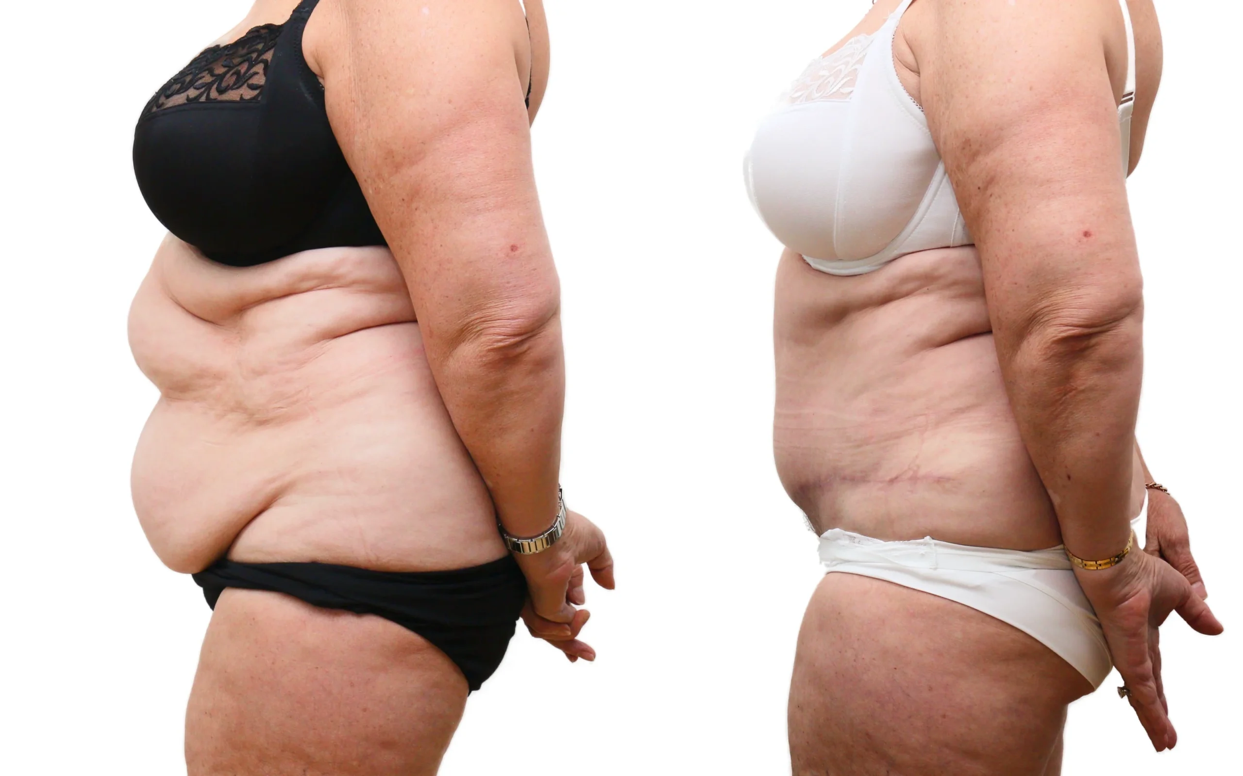 Transformational Tummy Tuck Result at 6 Months
