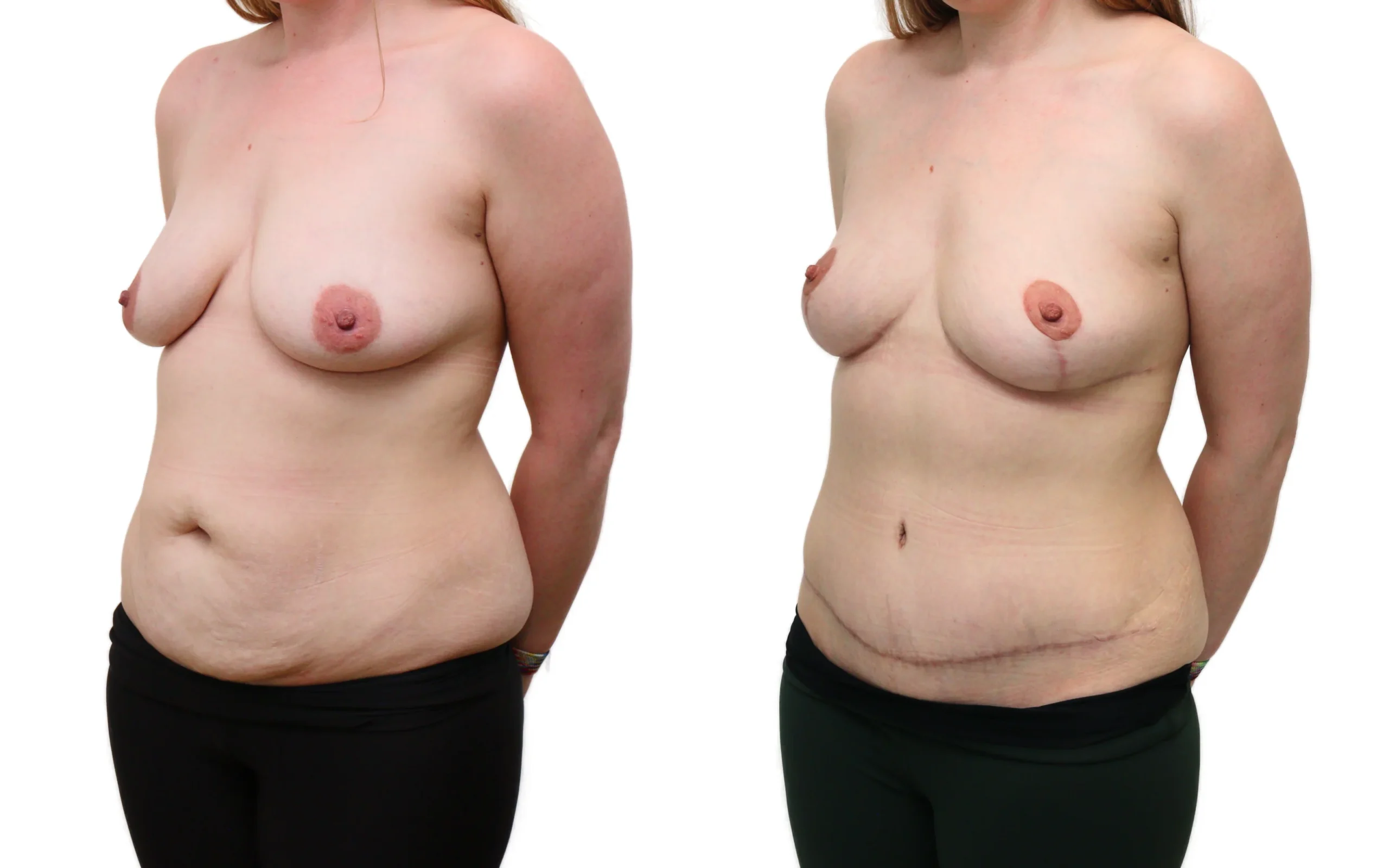 Combined Breast Uplift and Tummy Tuck After Pregnancy and Weight Loss