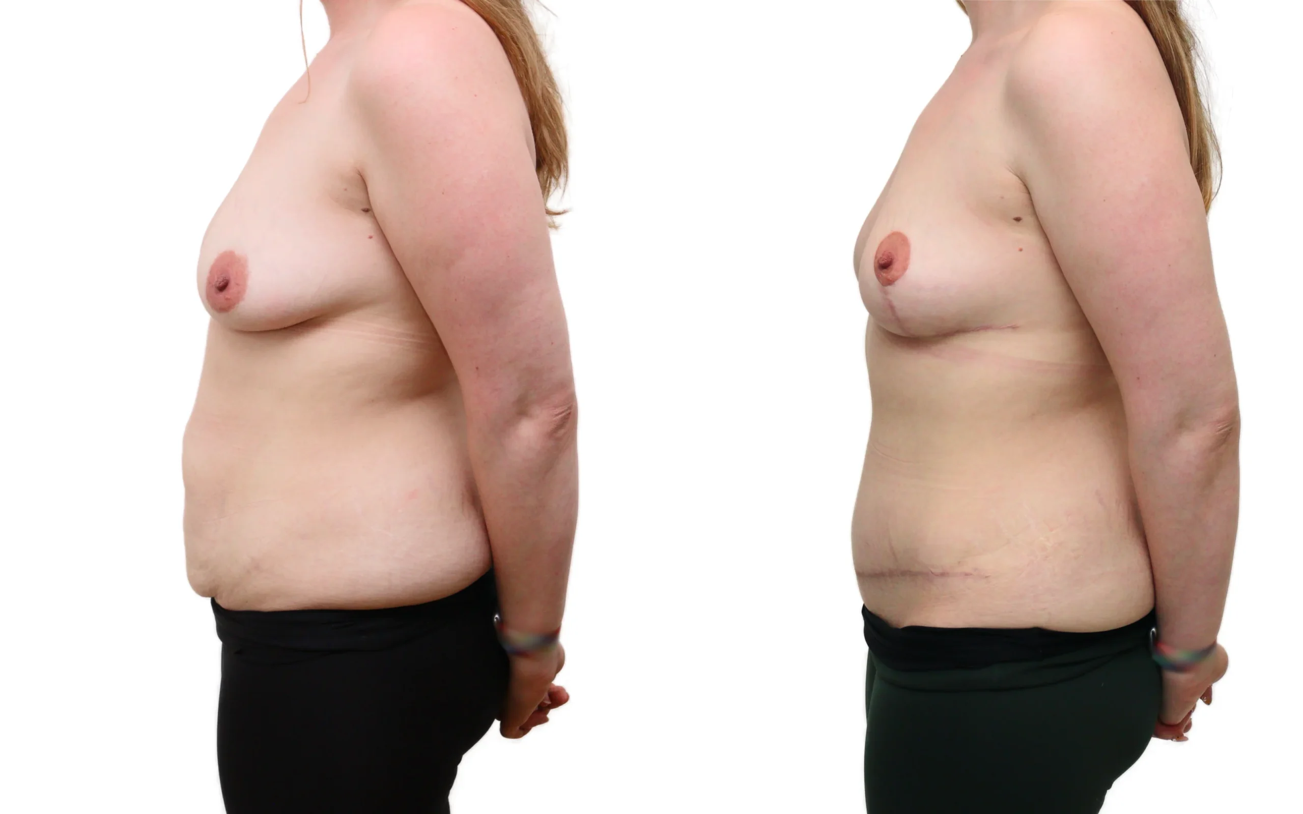 Combined Breast Uplift and Tummy Tuck After Pregnancy and Weight Loss