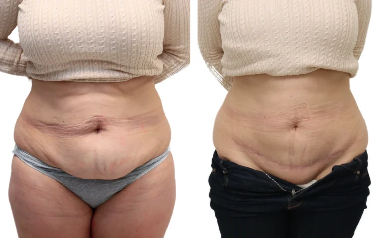 Before and after mini tummy tuck with liposuction – patient in her late 50s with lower abdominal overhang after C-sections…, photo 1 of 5