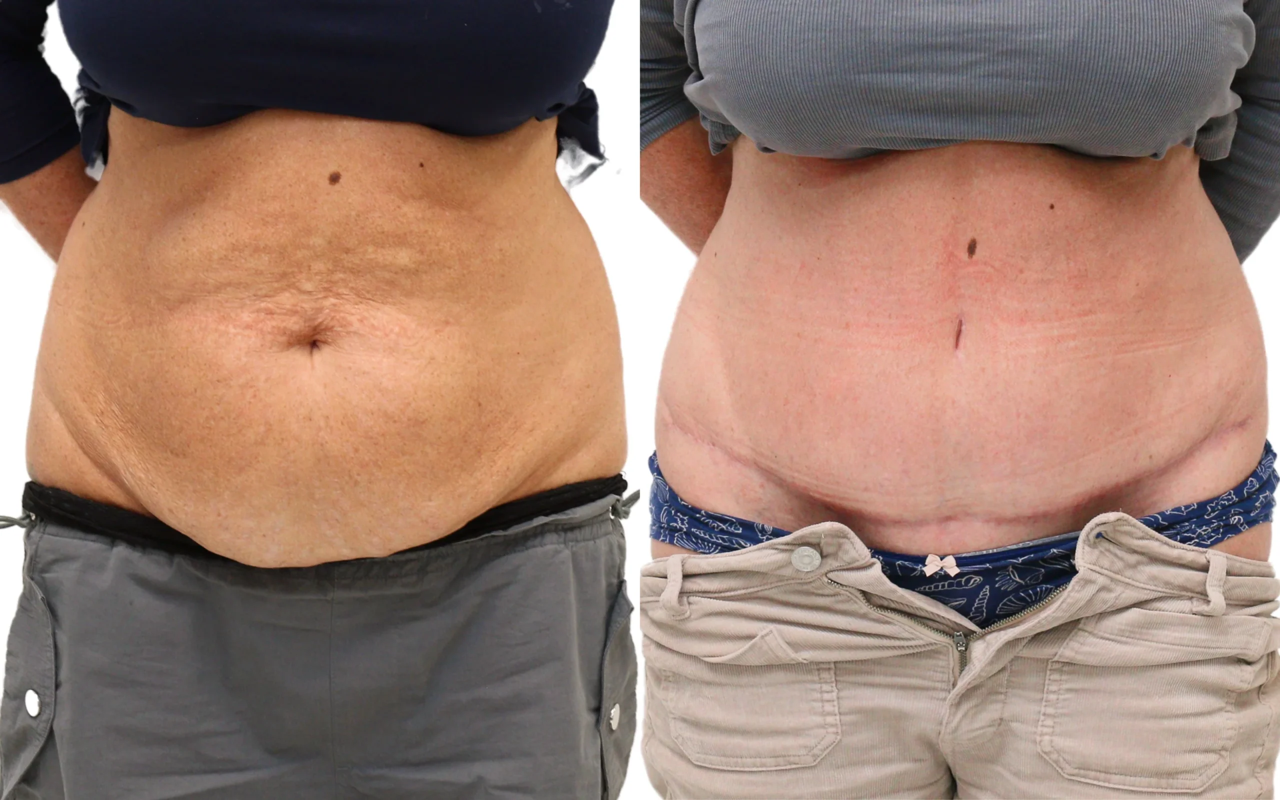 Before and after full tummy tuck (abdominoplasty) – patient in her mid-50s after two C-sections, 6 months post-op at quaba…, photo 1 of 5