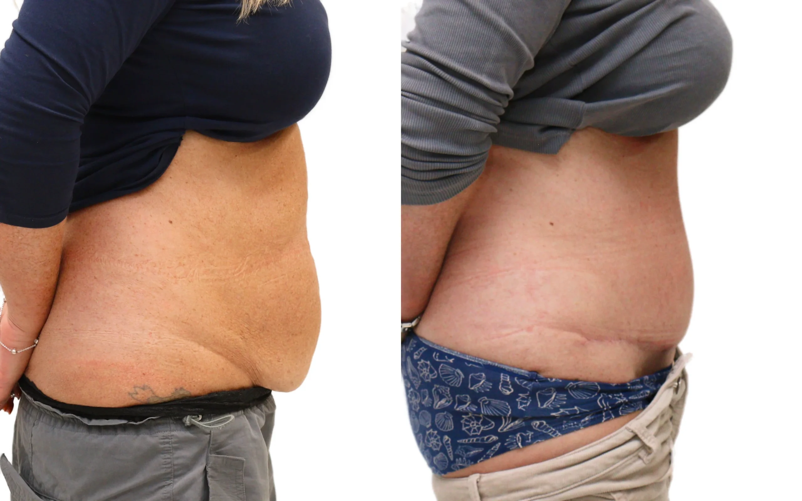 Before and after full tummy tuck (abdominoplasty) – patient in her mid-50s after two C-sections, 6 months post-op at quaba…, photo 2 of 5