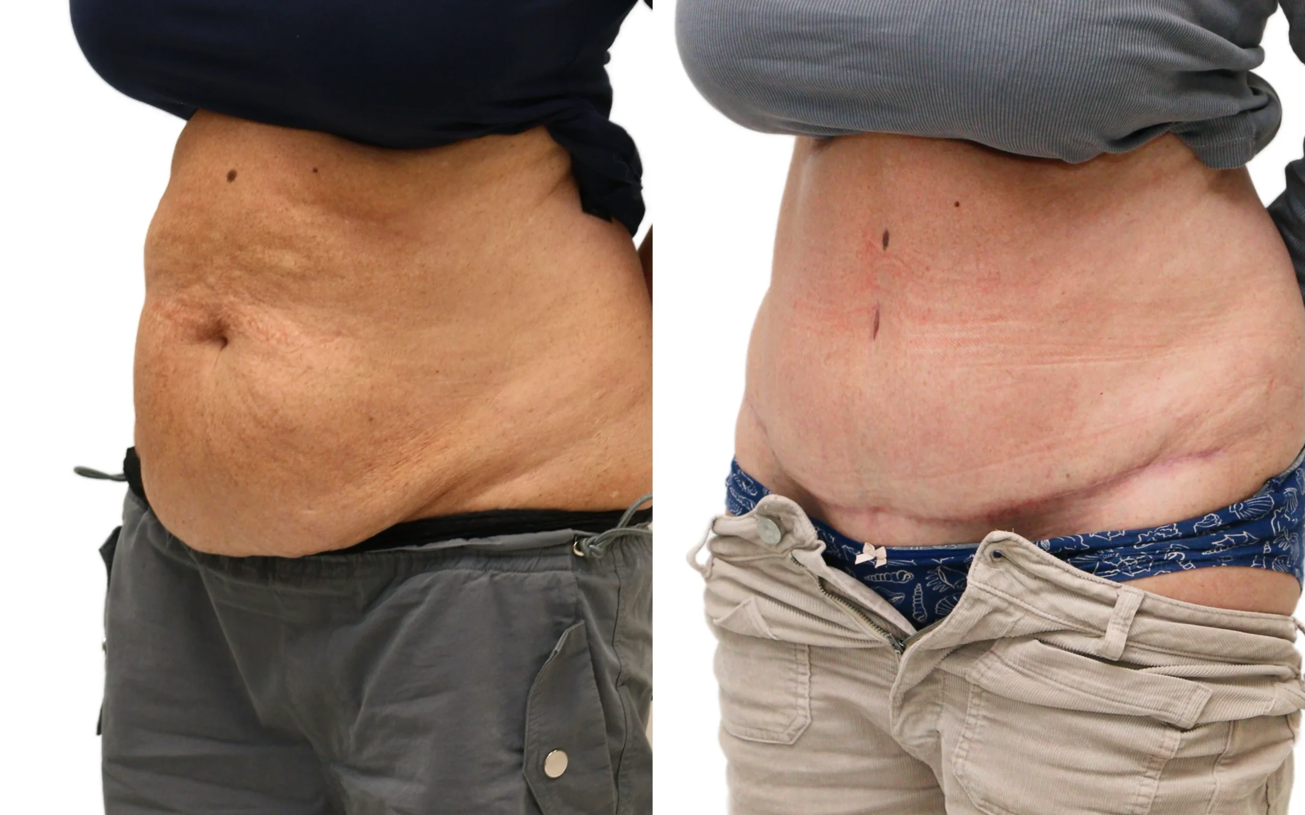 Before and after full tummy tuck (abdominoplasty) – patient in her mid-50s after two C-sections, 6 months post-op at quaba…, photo 4 of 5