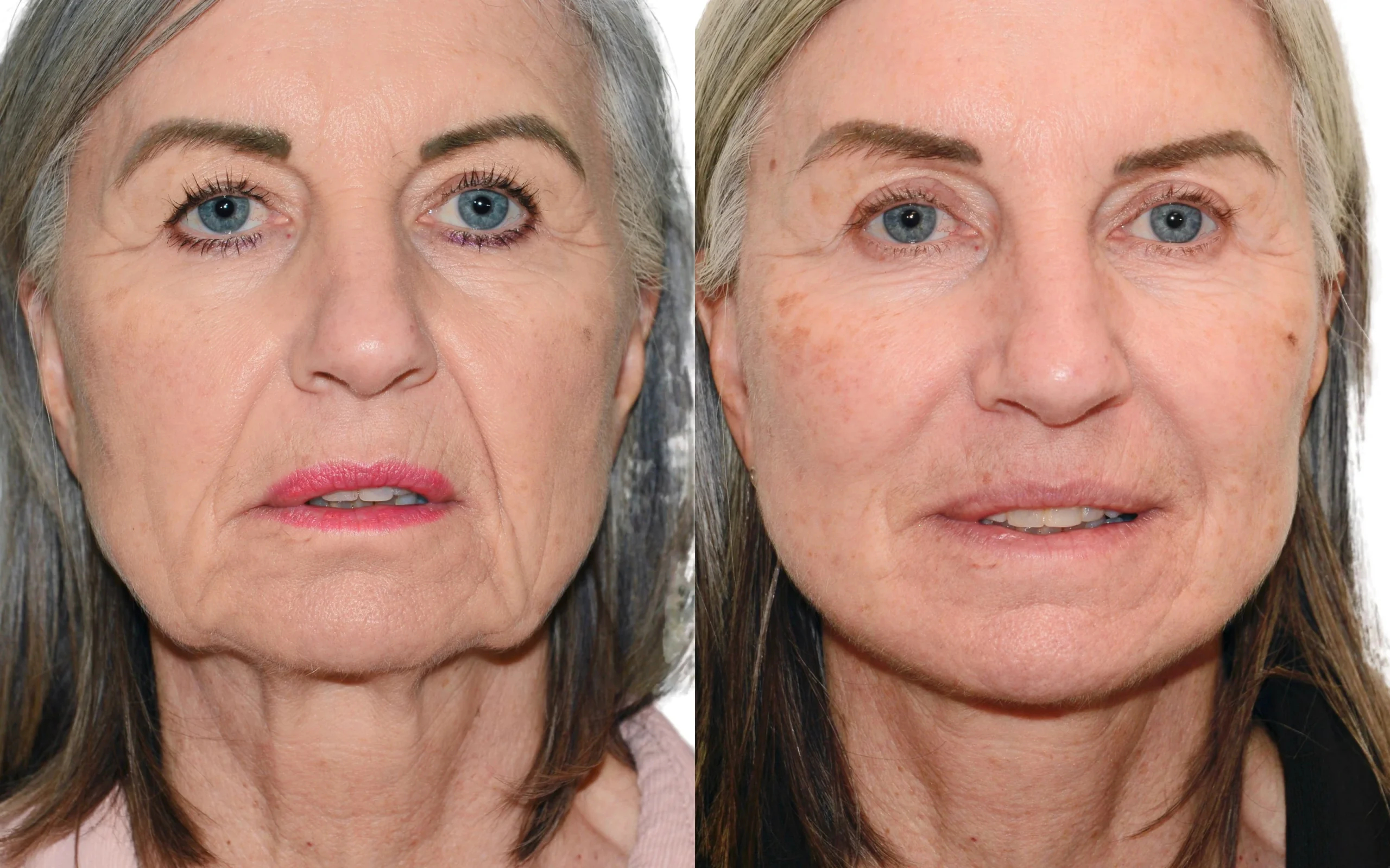 facelift surgery deep plane scotland