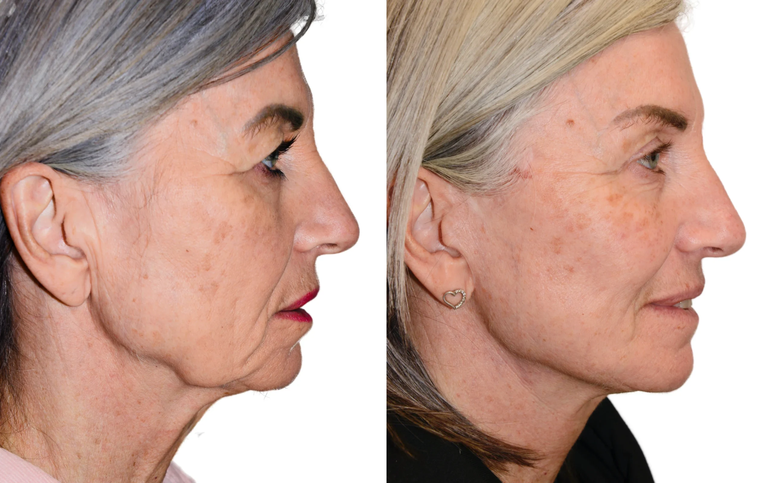 facelift surgery deep plane scotland