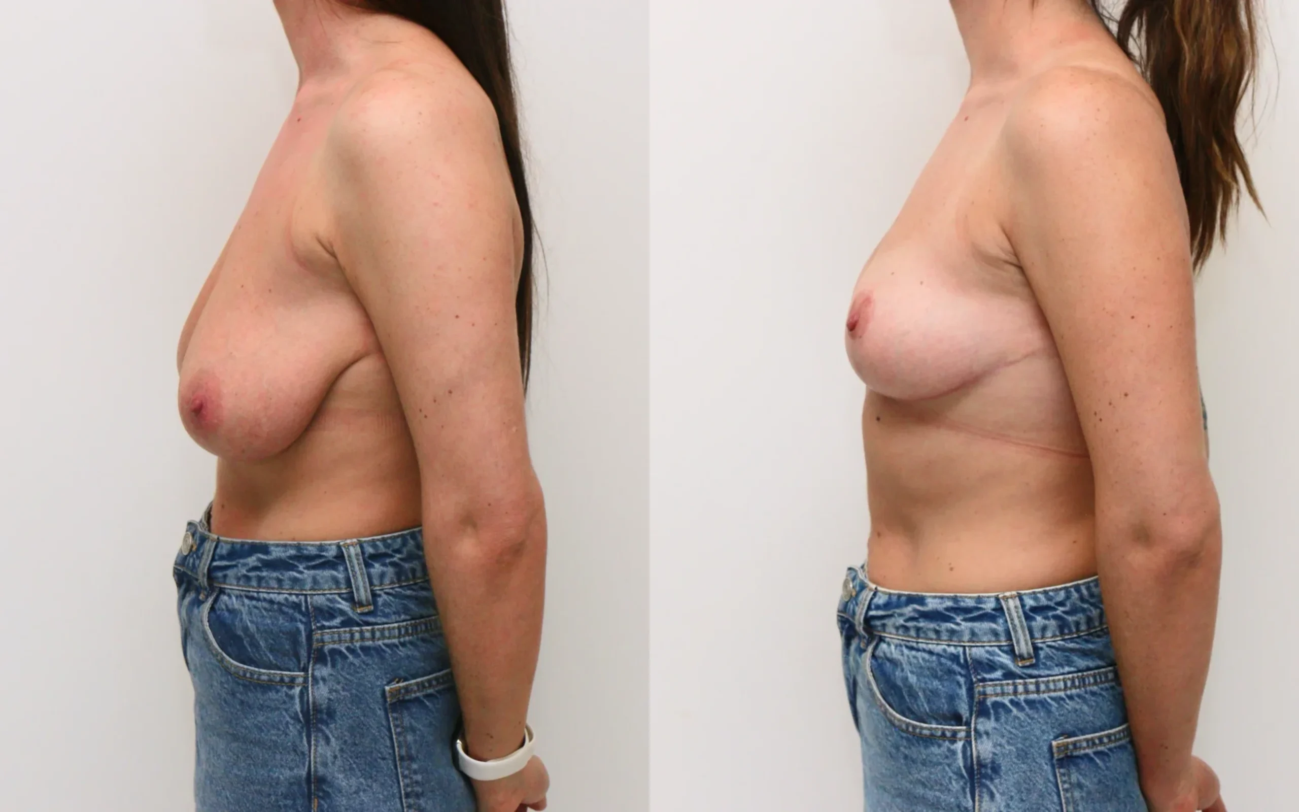 best breast uplift surgeons scorland