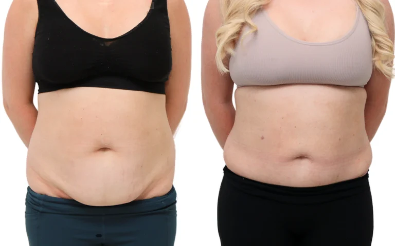 Mini tummy tuck before and after, photo 1 of 5