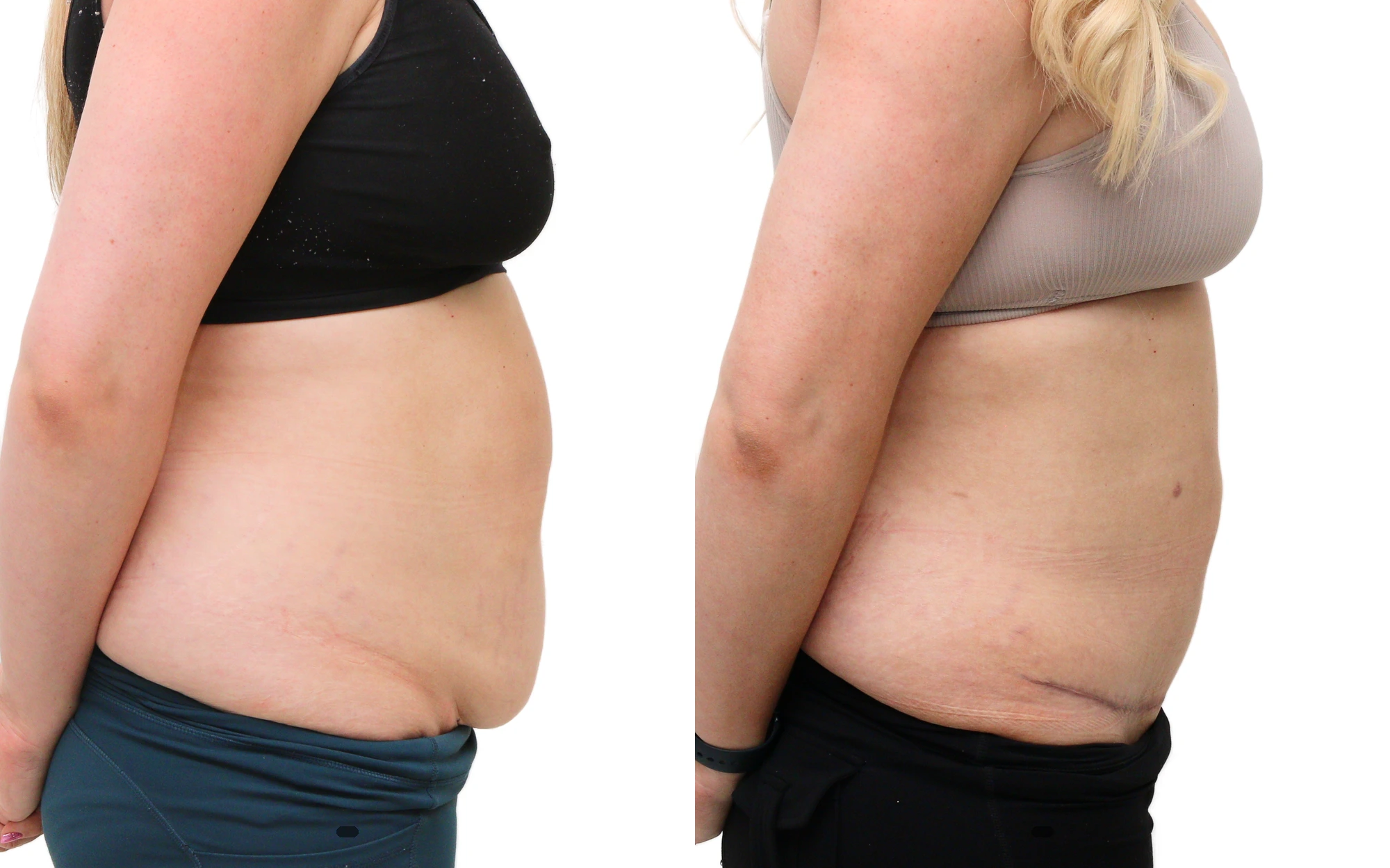 Mini tummy tuck before and after, photo 2 of 5