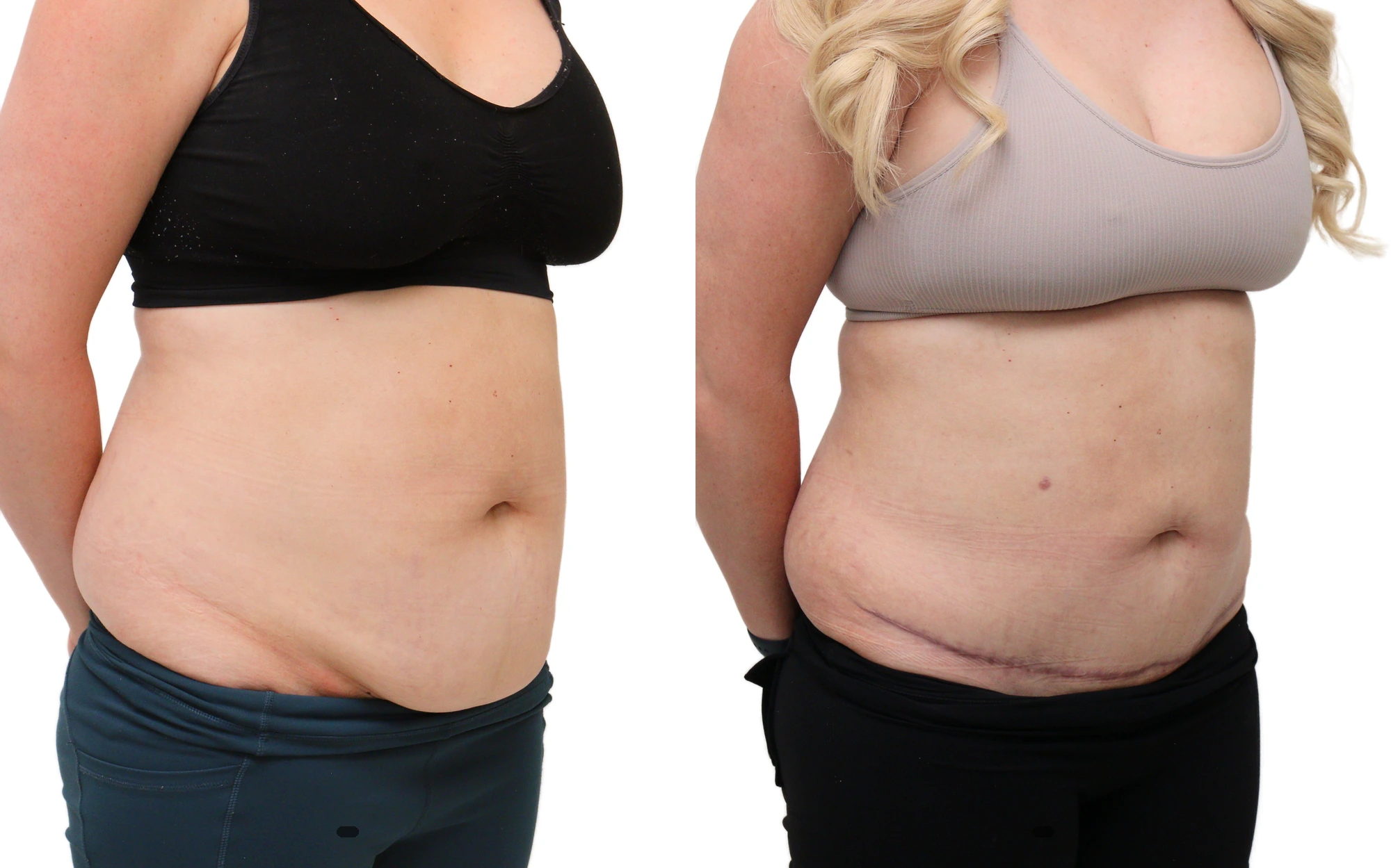 Mini tummy tuck before and after, photo 3 of 5