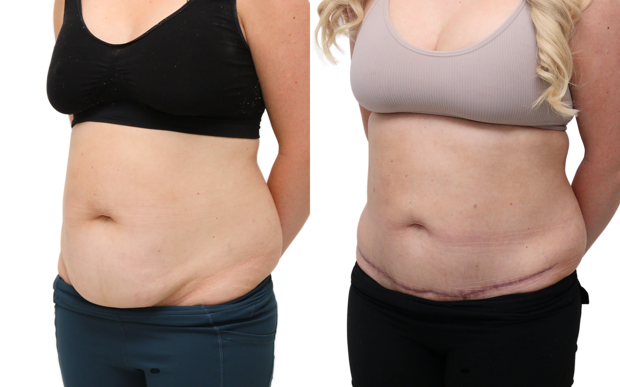 Mini tummy tuck before and after, photo 4 of 5