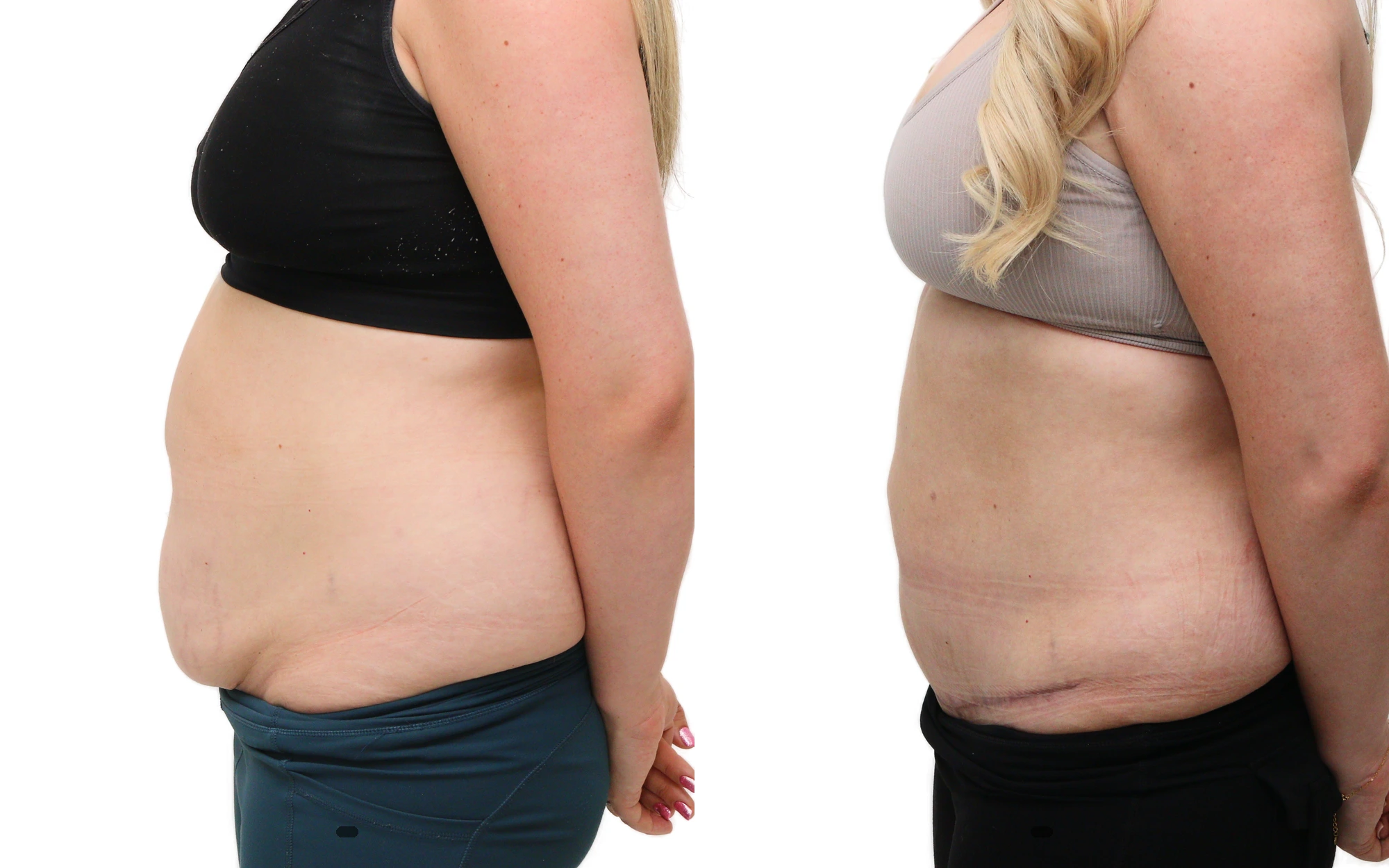 Mini tummy tuck before and after, photo 5 of 5