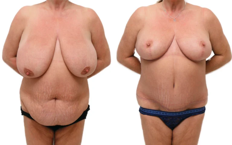 Full tummy tuck and breast reduction, before and after, photo 1 of 5