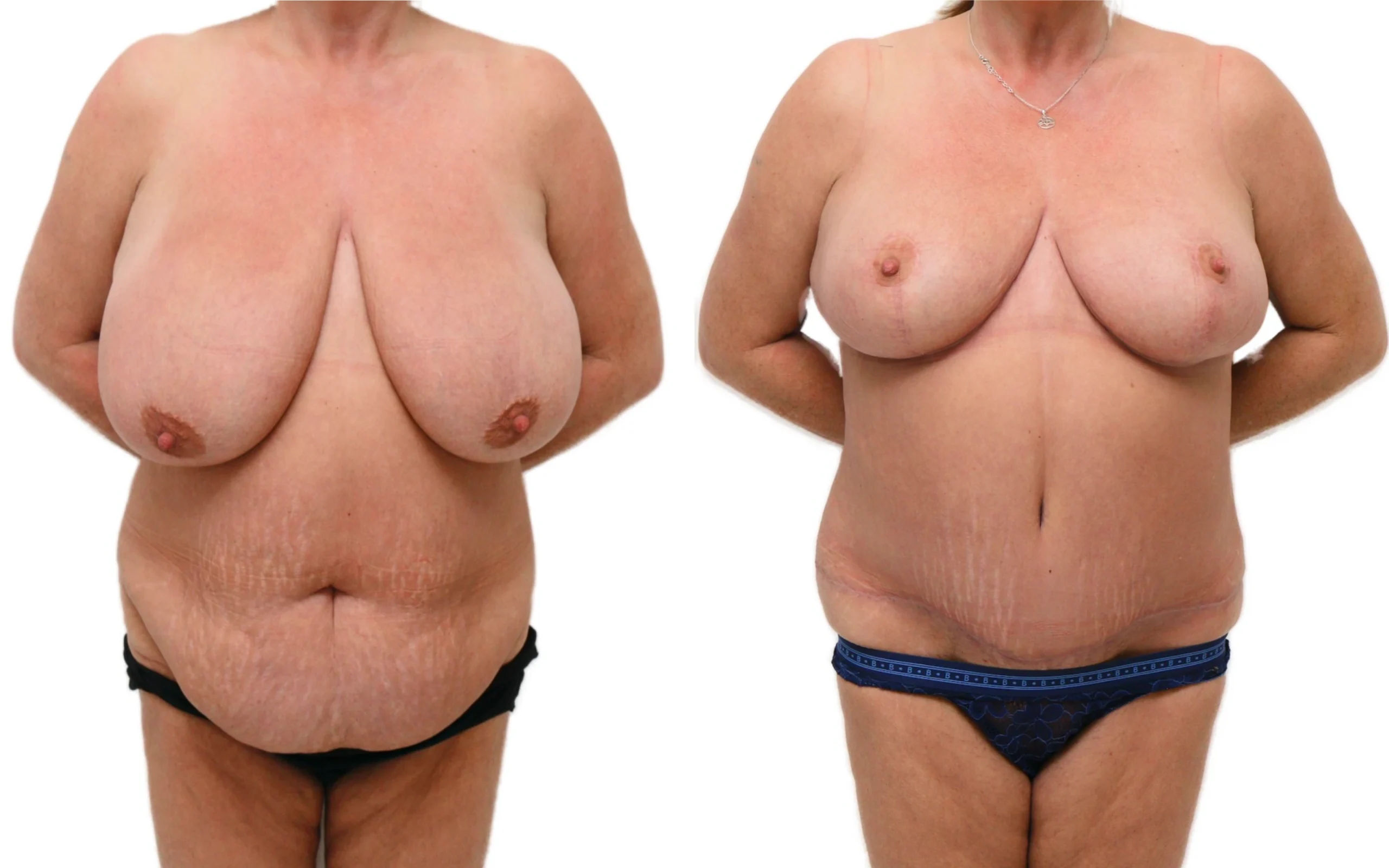 Full tummy tuck and breast reduction, before and after, photo 1 of 5