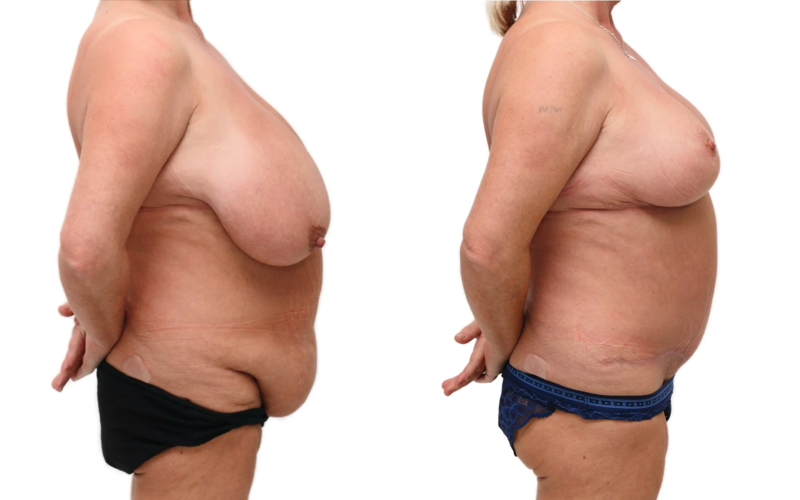 Full tummy tuck and breast reduction, before and after, photo 2 of 5