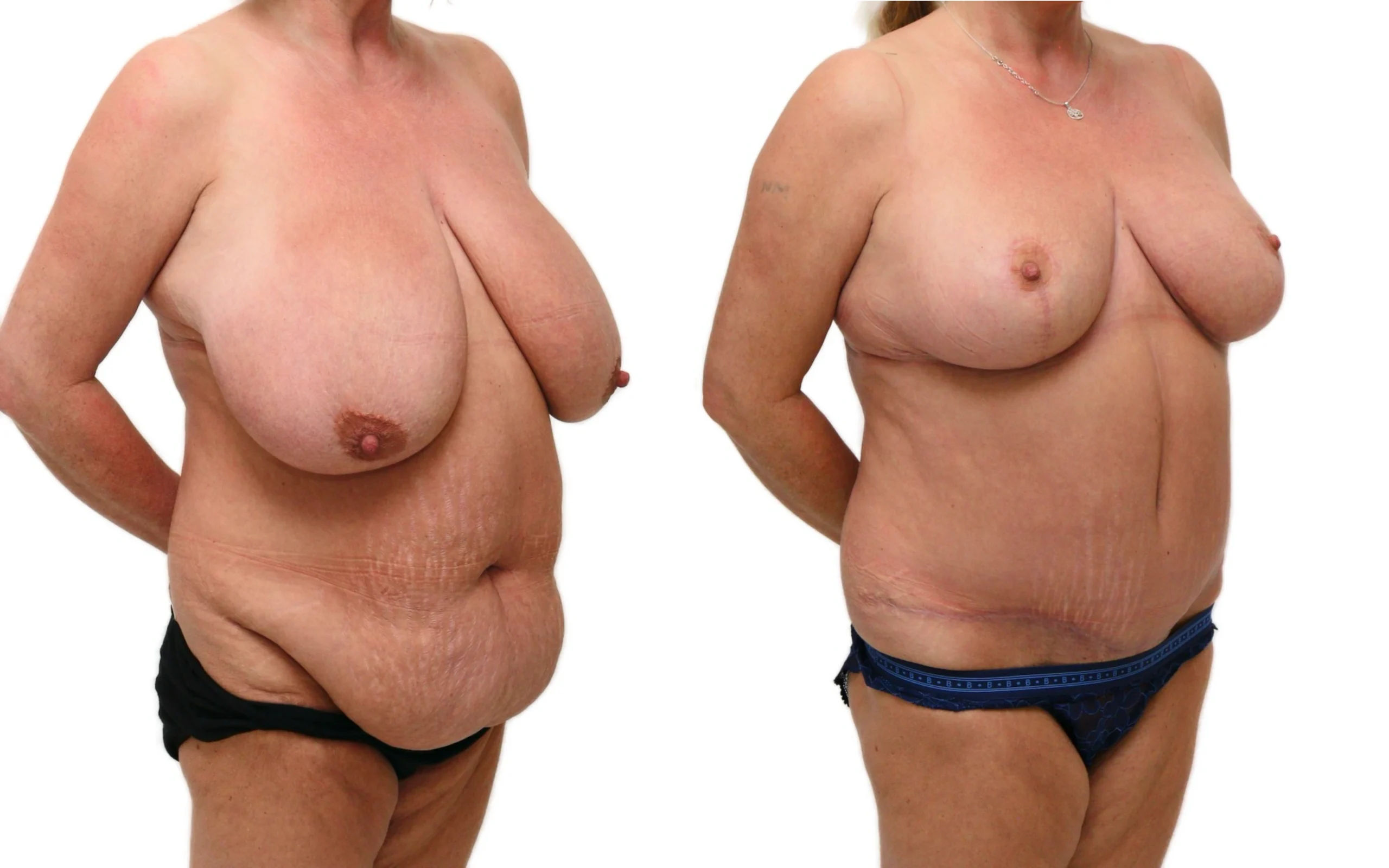 Full tummy tuck and breast reduction, before and after, photo 3 of 5