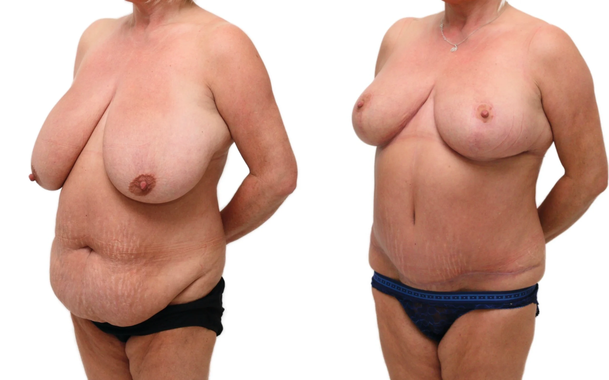 Full tummy tuck and breast reduction, before and after, photo 4 of 5