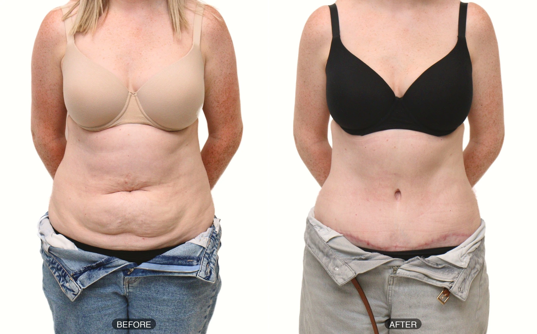 Full tummy tuck patient aged 38, before and after, photo 1 of 5