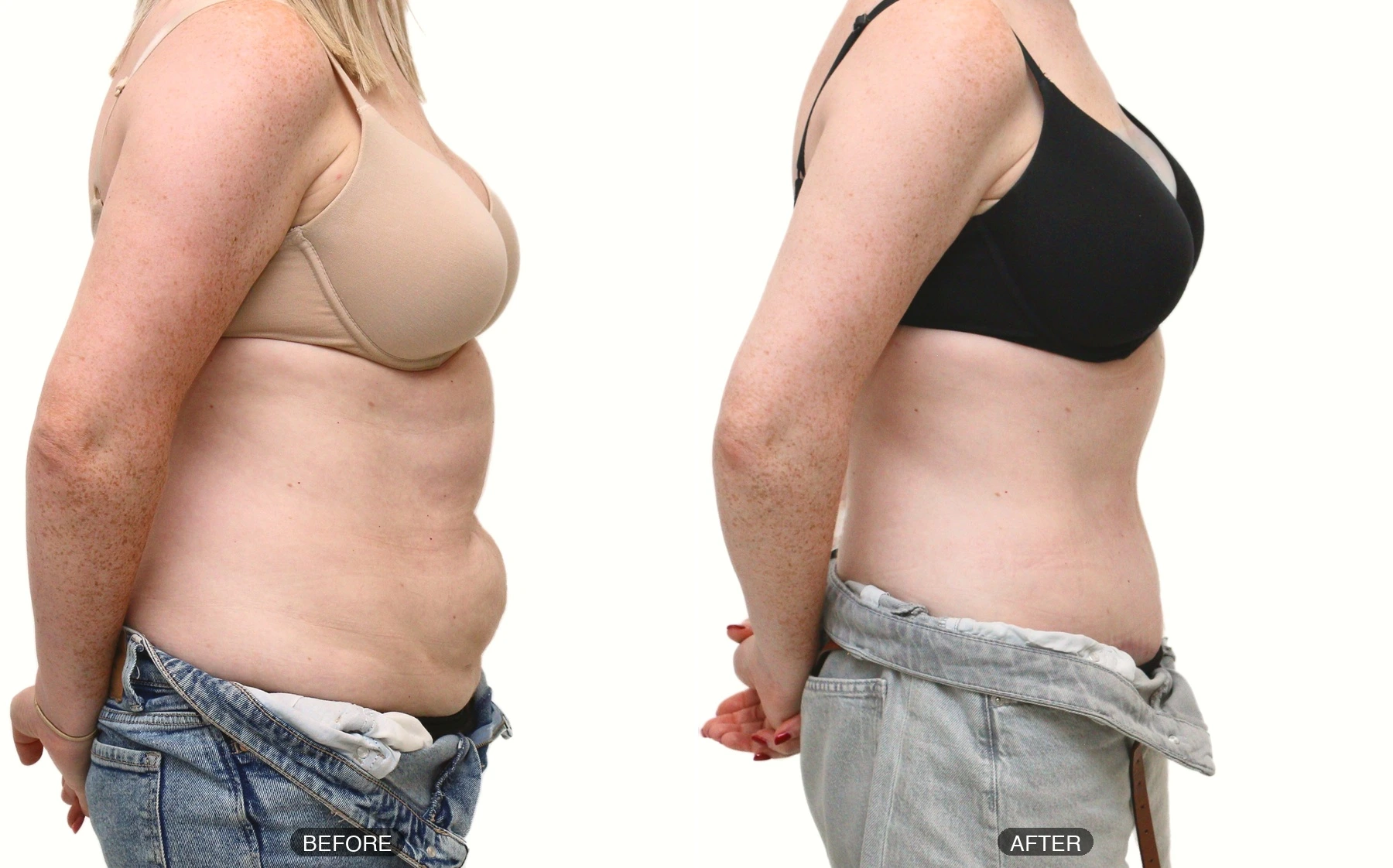 Full tummy tuck patient aged 38, before and after, photo 2 of 5