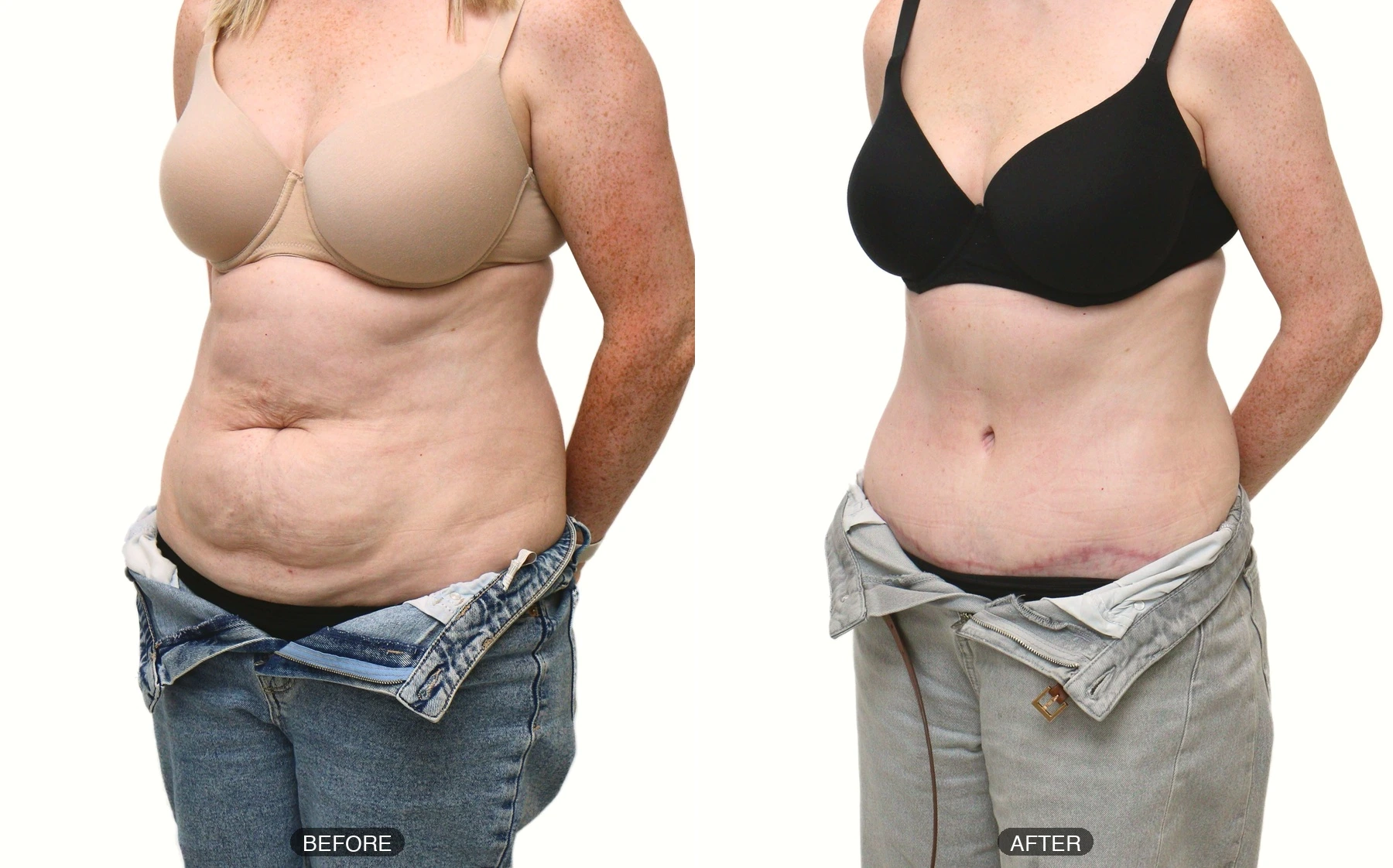 Full tummy tuck patient aged 38, before and after, photo 4 of 5