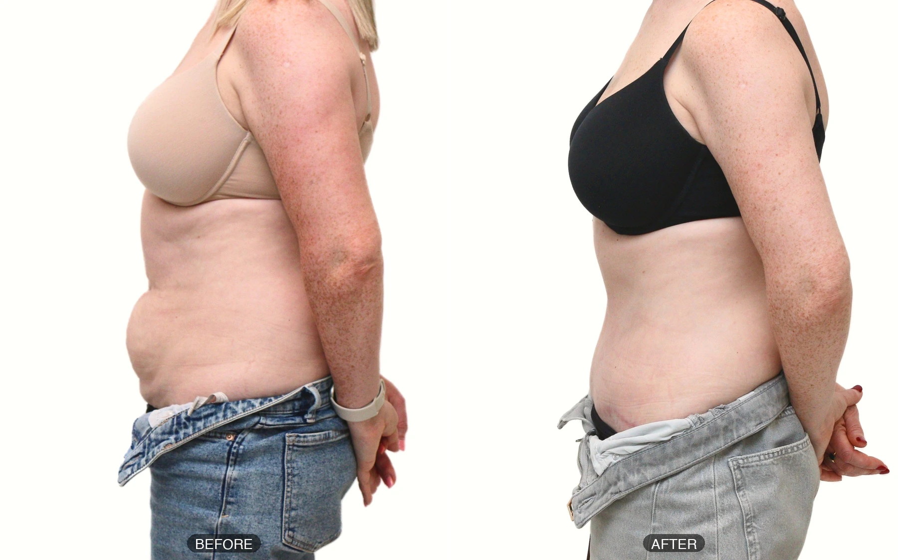 Full tummy tuck patient aged 38, before and after, photo 5 of 5