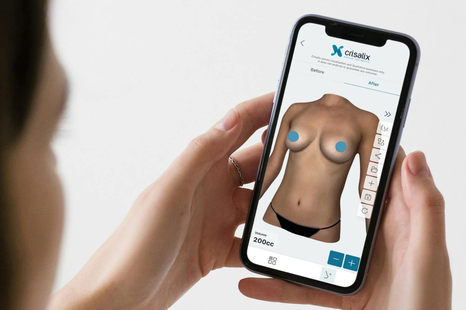 The Crisalix 3D app on a phone, comparing breast implant volumes